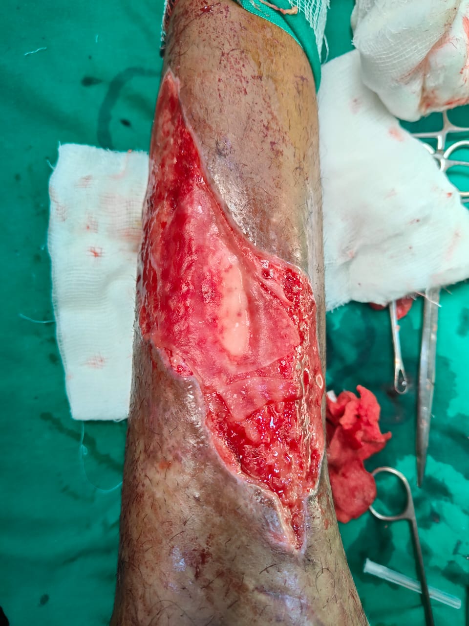 Dr Rahul Rathod General Surgeon and Laparoscopic Surgeon and Coloproctologist in Nagpur 11