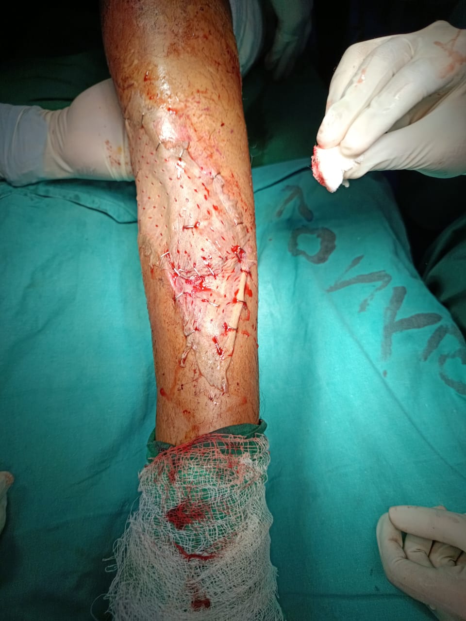 Dr Rahul Rathod General Surgeon and Laparoscopic Surgeon and Coloproctologist in Nagpur 12