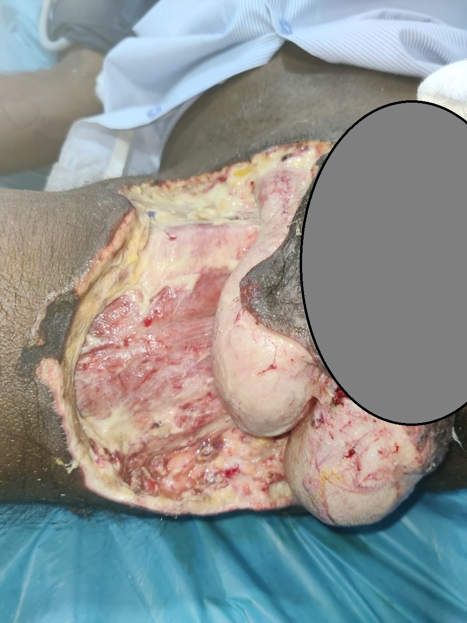 Dr Rahul Rathod General Surgeon and Laparoscopic Surgeon and Coloproctologist in Nagpur 15