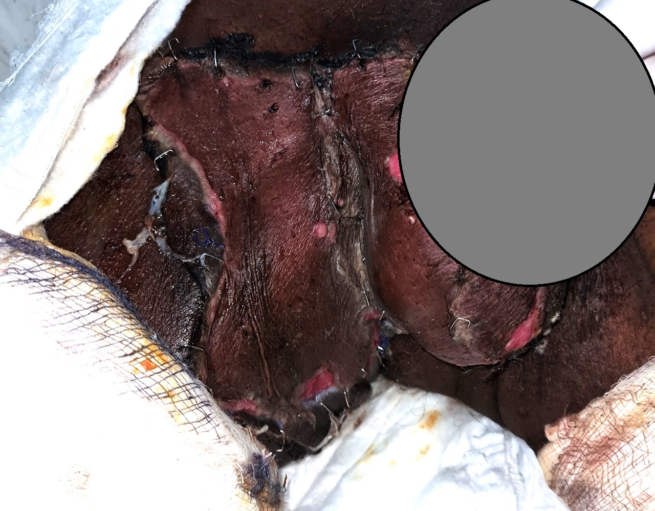 Dr Rahul Rathod General Surgeon and Laparoscopic Surgeon and Coloproctologist in Nagpur 16