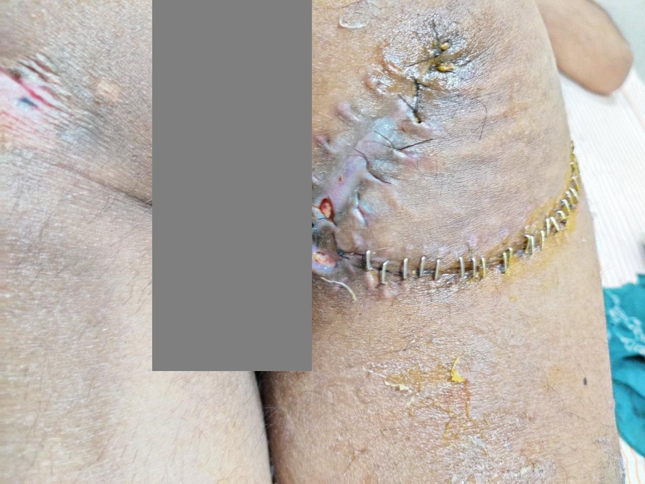 Dr Rahul Rathod General Surgeon and Laparoscopic Surgeon and Coloproctologist in Nagpur 18