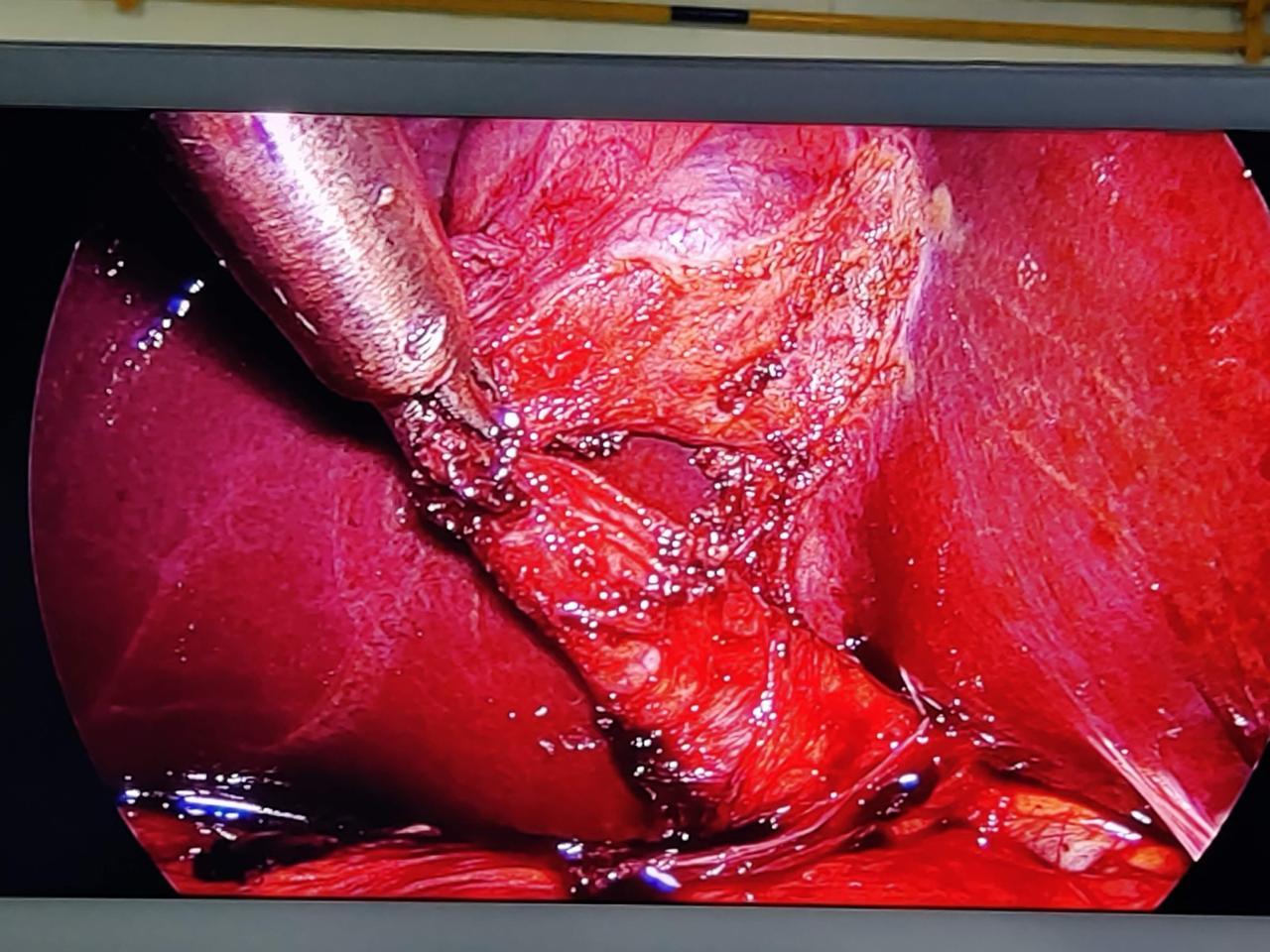 Dr Rahul Rathod General Surgeon and Laparoscopic Surgeon and Coloproctologist in Nagpur 19