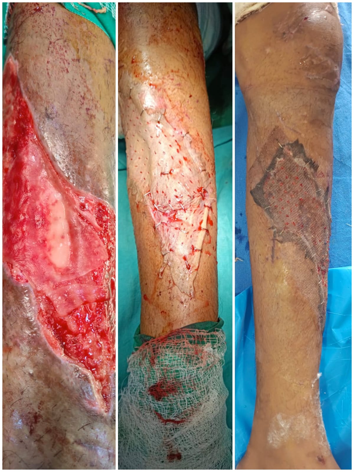 Tissue expander over tibia with skin grafting 1